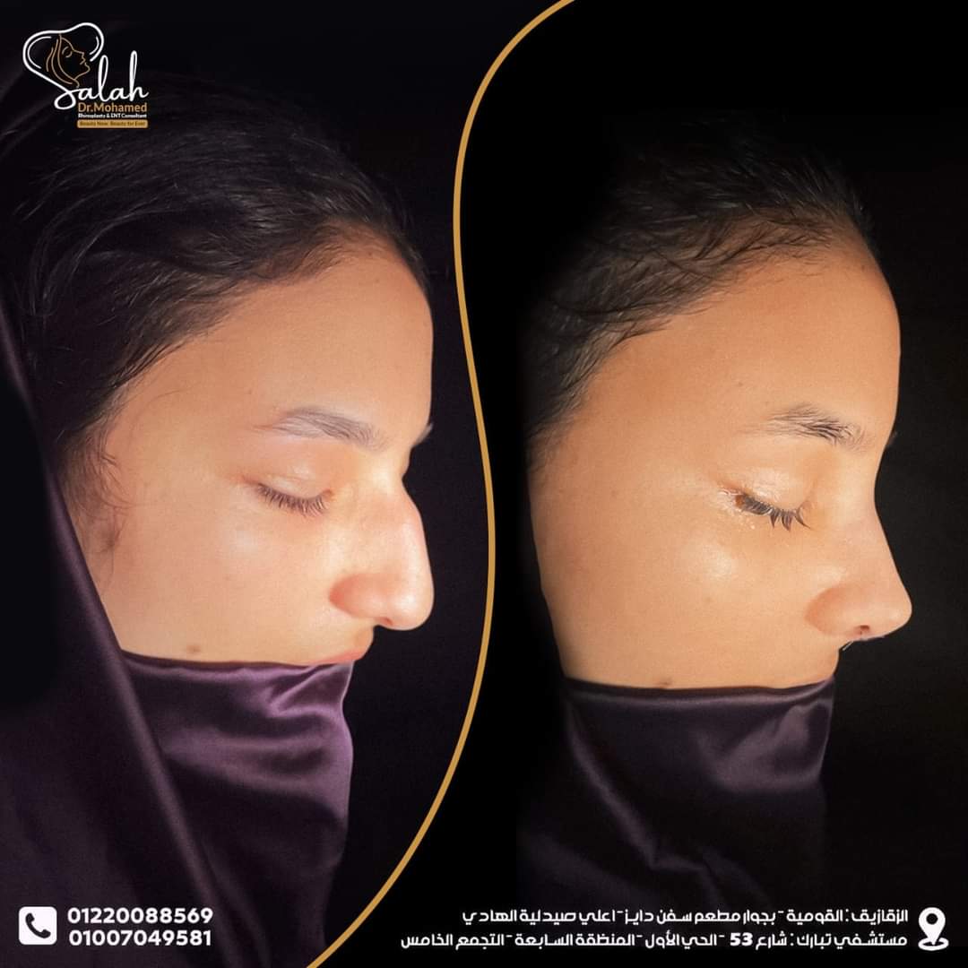 Over-Projected Nose Rhinoplasty